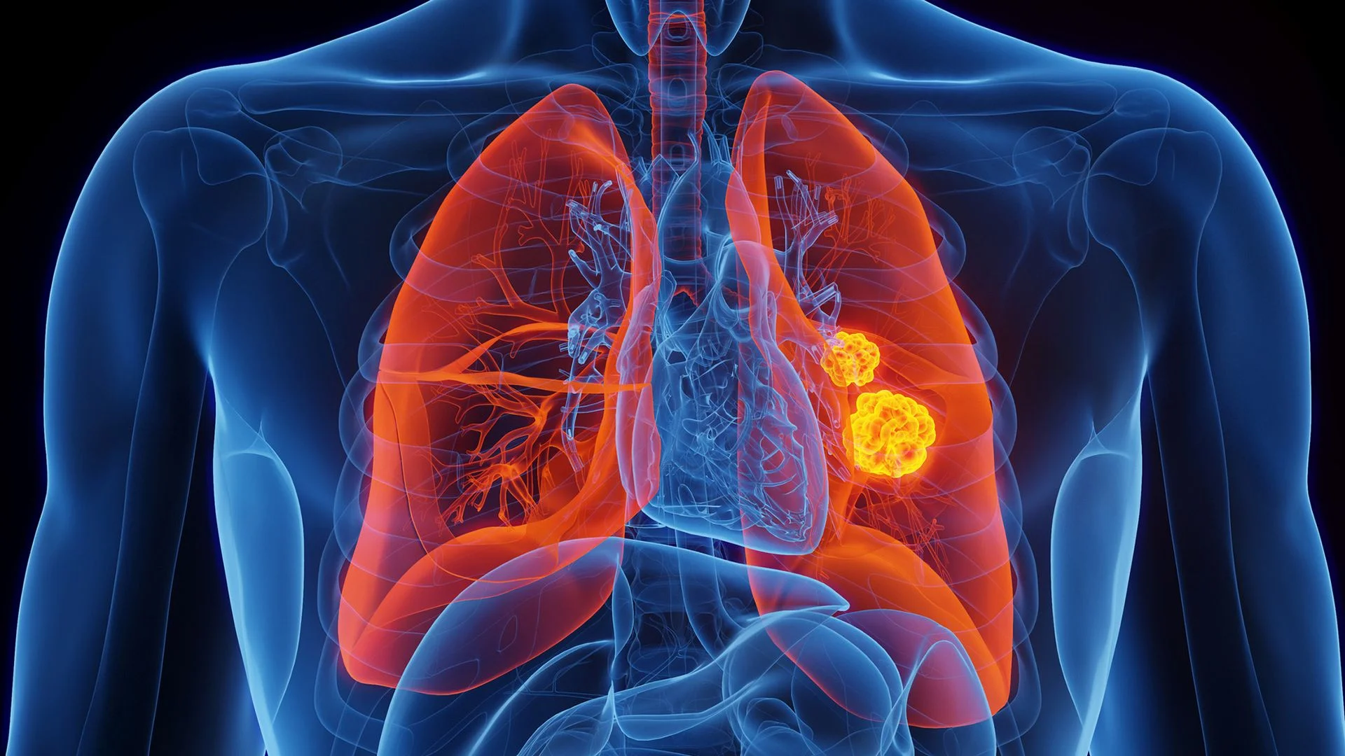 New Genetic Mutation Found to Significantly Raise Lung Cancer Risk in Nonsmokers